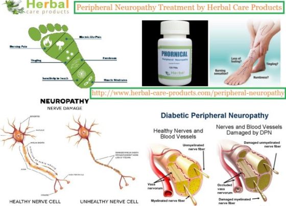 Treatment for Peripheral Neuropathy by Natural Herbal Remedies