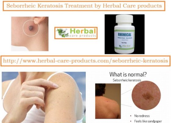 Treatment of Seborrheic Keratosis Symptoms
