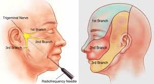 Trigeminal Neuralgia Treatment, Symptoms and Causes