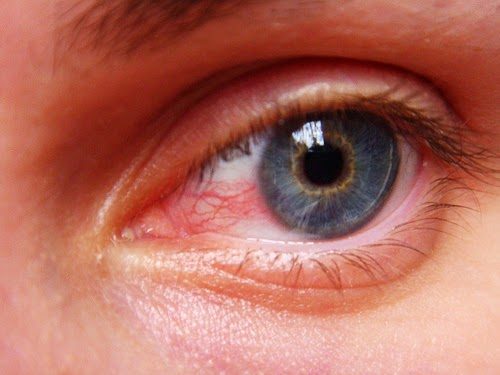 Uveitis Natural Remedies, Symptoms Causes and Home Treatment