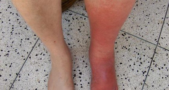What Is Cellulitis Symptoms, Causes And Infection