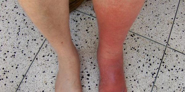 What Is Cellulitis Symptoms, Causes And Infection