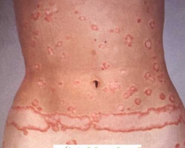 What Is Granuloma Annulare Symptoms, Causes And Treatment