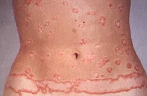 What Is Granuloma Annulare Symptoms, Causes And Treatment