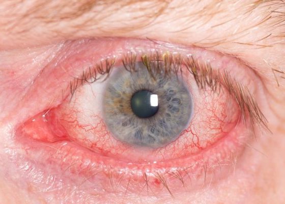 What Is Uveitis Symptoms, Causes And Treatment