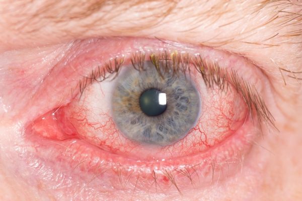 What Is Uveitis Symptoms, Causes And Treatment