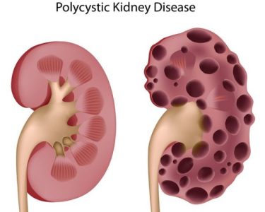 What Natural Treatments for Reversing Polycystic Kidney Disease