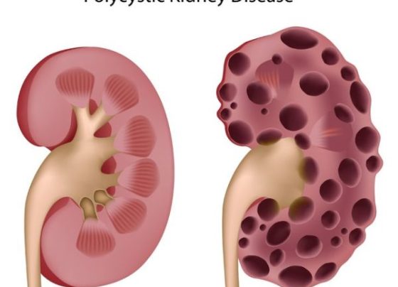 What Natural Treatments for Reversing Polycystic Kidney Disease