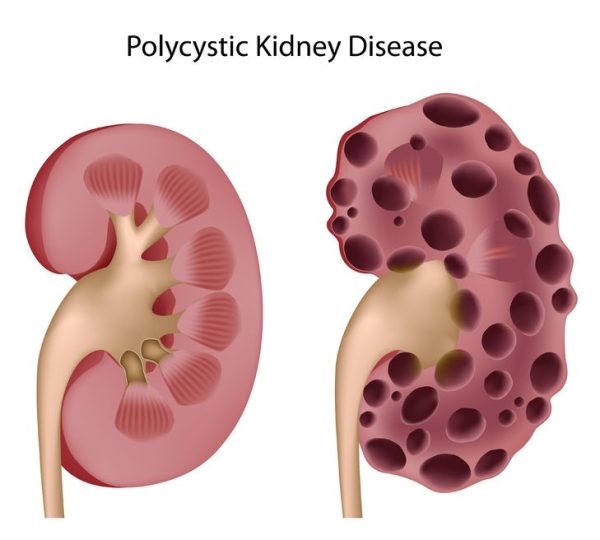 What Natural Treatments for Reversing Polycystic Kidney Disease