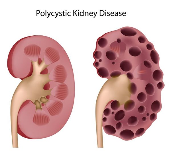 What Natural Treatments for Reversing Polycystic Kidney Disease