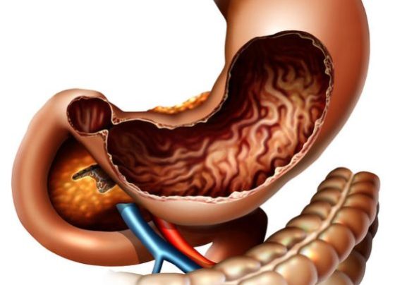 What is Diabetic Gastroparesis Symptoms, Causes and Treatment