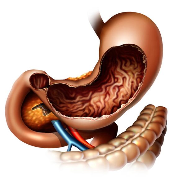 What is Diabetic Gastroparesis Symptoms, Causes and Treatment