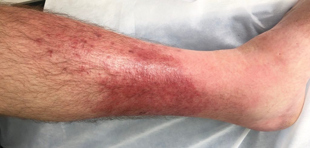 cellulitis