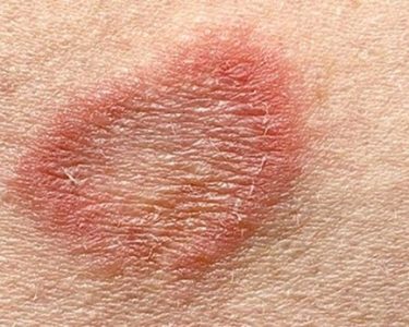 ringworm-type-appearances-of-bumps-symptoms-and-its-treatment