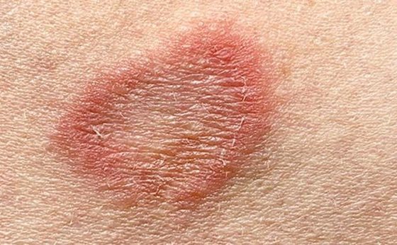ringworm-type-appearances-of-bumps-symptoms-and-its-treatment
