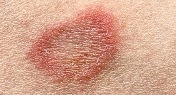 ringworm-type-appearances-of-bumps-symptoms-and-its-treatment