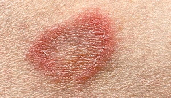 Ringworm type appearances of bumps: Symptoms and its treatment