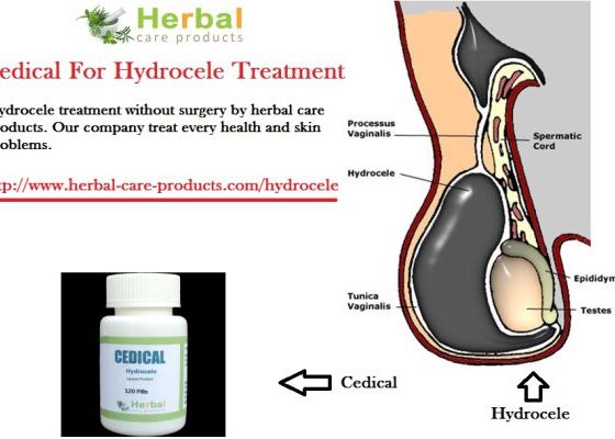 10 Natural Remedies for Hydrocele