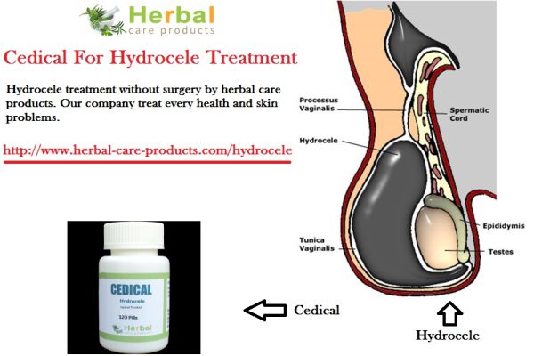 10 Natural Remedies for Hydrocele