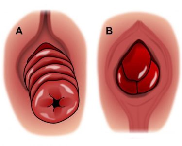 Herbal Remedies for Rectal Prolapse