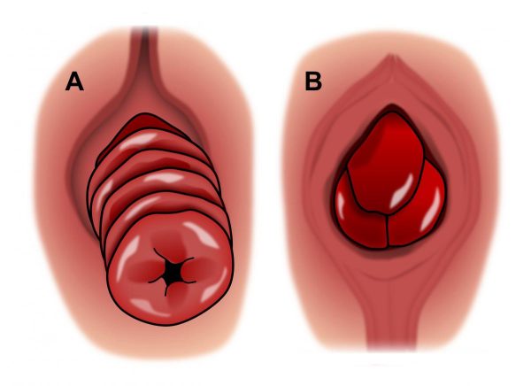 Herbal Remedies for Rectal Prolapse