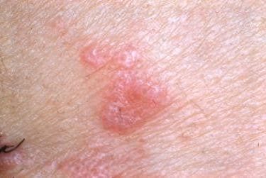 Herbal Treatment for Lichen Planus and Its Promising Solution