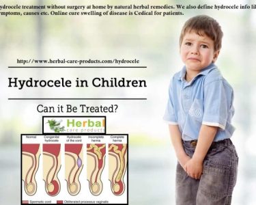 Hydrocele Natural Herbal Remedies for Pain