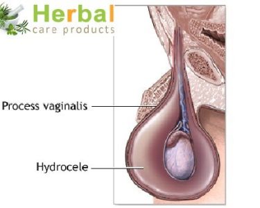 Hydrocele Symptoms, Causes, Diagnosed and Treatment