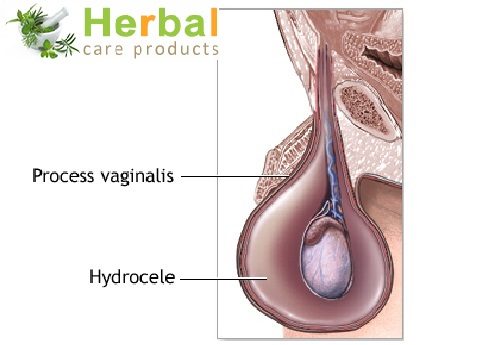 Hydrocele Symptoms, Causes, Diagnosed and Treatment