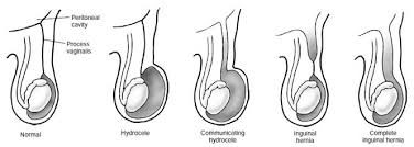 Hydrocele - Vericocele Disorder