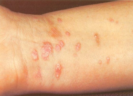 Lichen Planus - Annular Pattern Disease - Skin Disorder