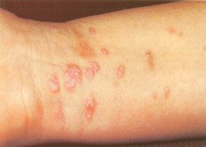 Lichen Planus Treatment by Natural Skin Care Products