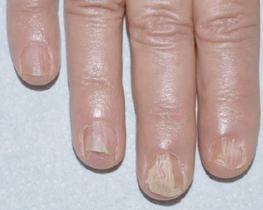 Mastering Lichen Planus Nails Treatment