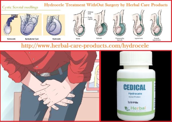 Natural Herbal Treatment for Hydrocele and Symptoms, Causes
