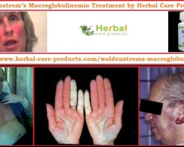 Natural Herbal Treatment for Waldenstrom’s Macroglobulinemia