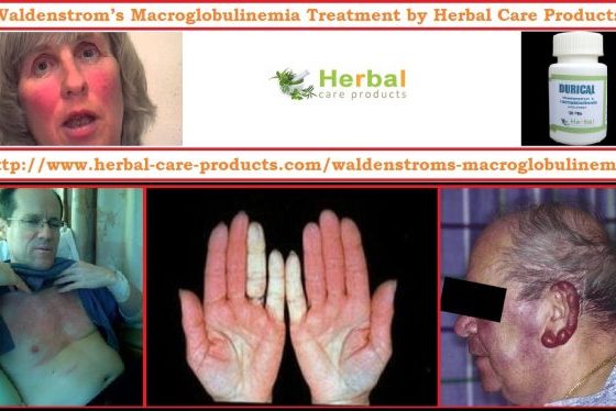 Natural Herbal Treatment for Waldenstrom’s Macroglobulinemia