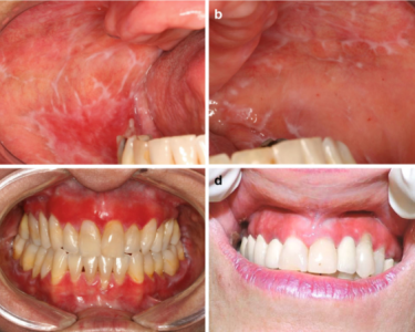 Oral Lichen Planus vs Leukoplakia