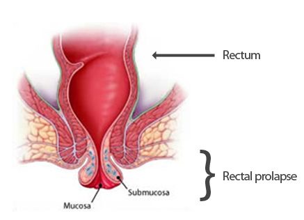 Rectal Prolapse – Mucosal Prolapse