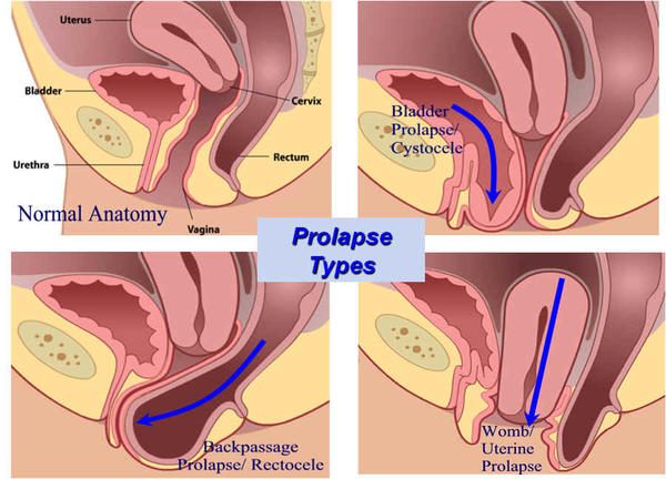 Rectal Prolapse Symptoms and Prolapsed Bowel Treatment