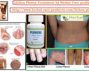 Treatment for Lichen Planus by Natural Herbal Remedies