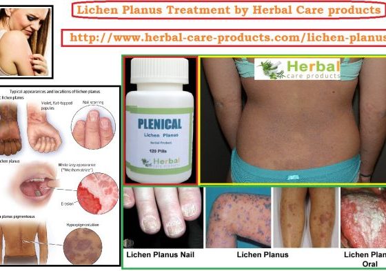 Treatment for Lichen Planus by Natural Herbal Remedies