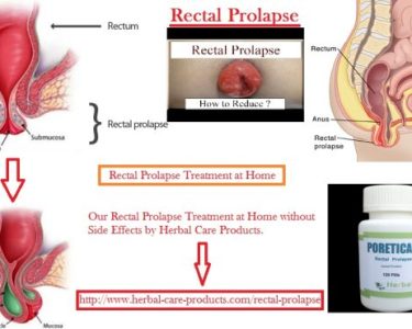 Treatment of Rectal Prolapse Symptoms