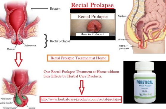 Treatment of Rectal Prolapse Symptoms