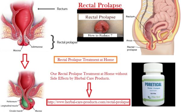 Treatment of Rectal Prolapse Symptoms