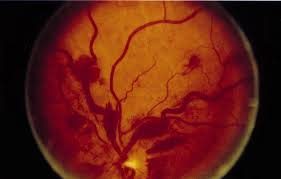 Waldenstrom’s Macroglobulinemia – Lymphoplasmacytic Disorder