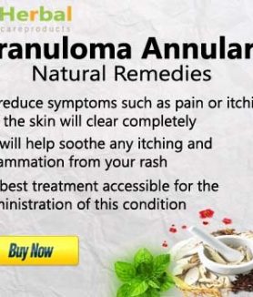 Treatment of Granuloma Annulare With Herbal Remedies