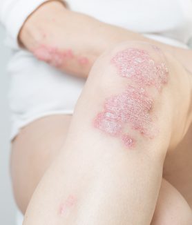 Diagnosis and Management of Nail Psoriasis and Nail Lichen Planus