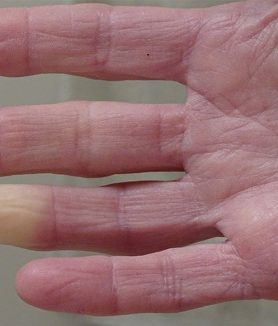 Scleroderma Diagnosis, Treatment, and Care