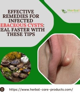 Effective Remedies for Infected Sebaceous Cysts