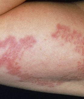 Granuloma Annulare Rash - Herbal Care Products